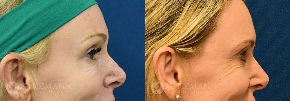 Eyelid Lift Before & After