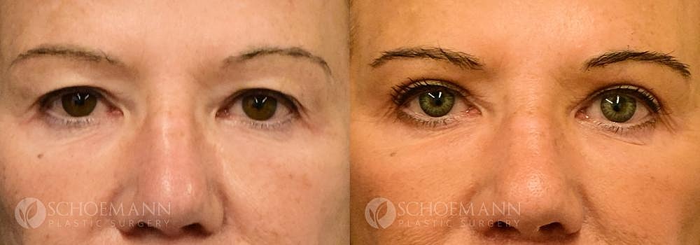 Eyelid Lift Before & After