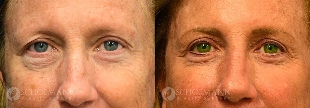 Eyelid Lift Before & After