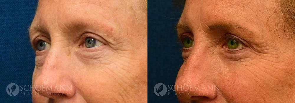 Eyelid Lift Before & After