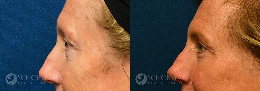 Eyelid Lift Before & After