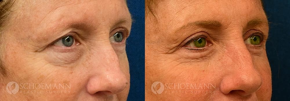 Eyelid Lift Before & After