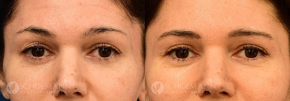 Eyelid Lift Before & After