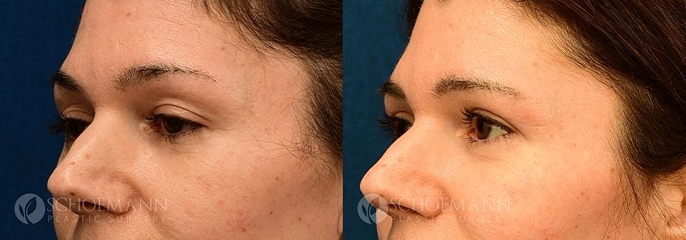 Eyelid Lift Before & After
