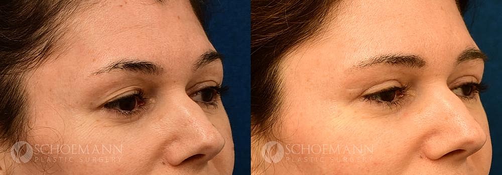 Eyelid Lift Before & After