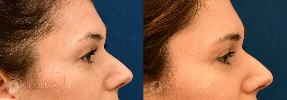 Eyelid Lift Before & After