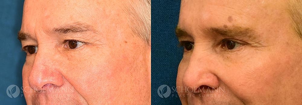 Eyelid Lift Before & After