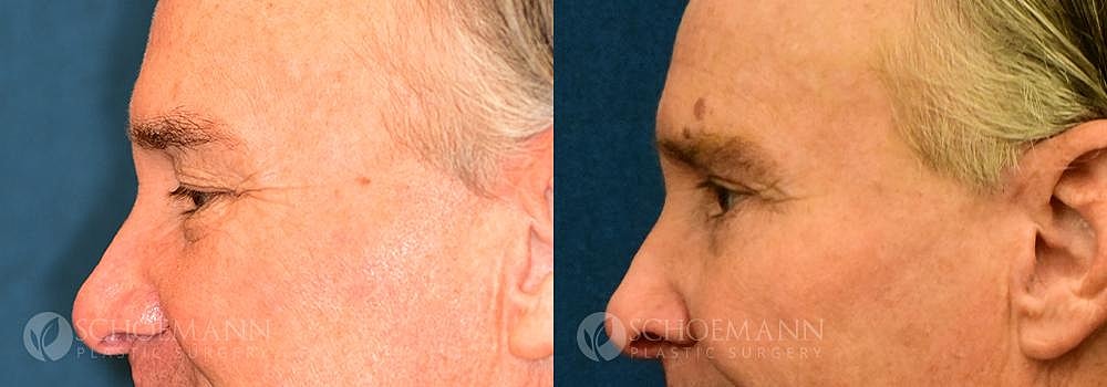 Eyelid Lift Before & After