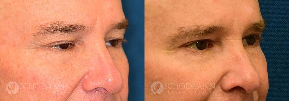 Eyelid Lift Before & After
