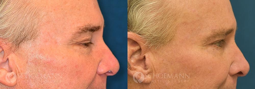 Eyelid Lift Before & After