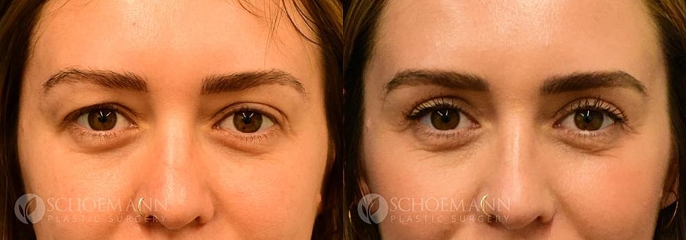 Eyelid Lift Before & After