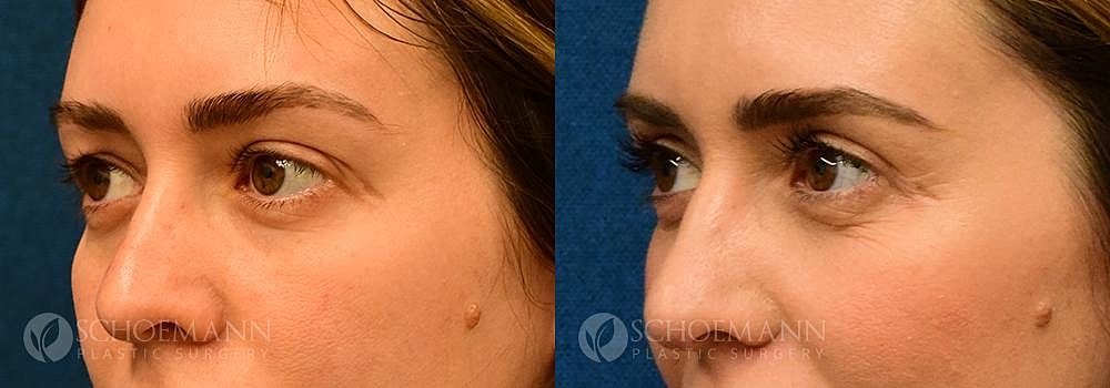 Eyelid Lift Before & After