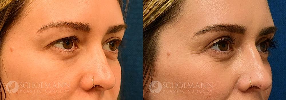 Eyelid Lift Before & After
