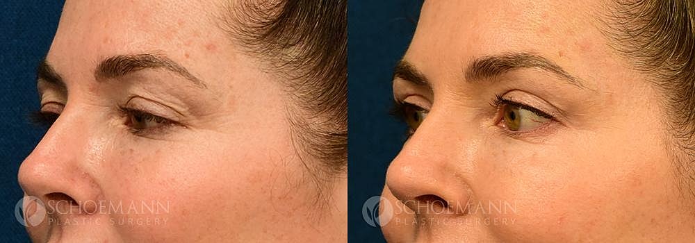 Eyelid Lift Before & After