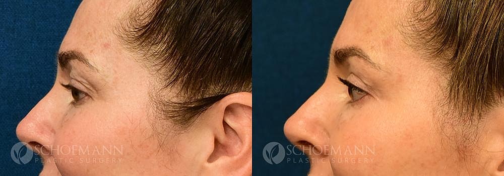 Eyelid Lift Before & After