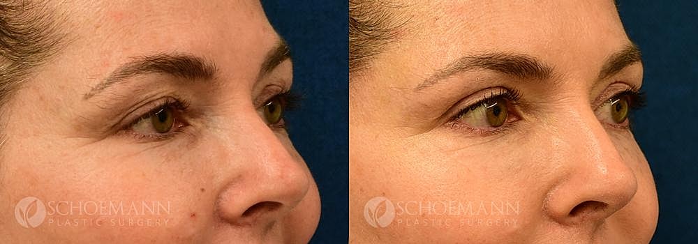 Eyelid Lift Before & After