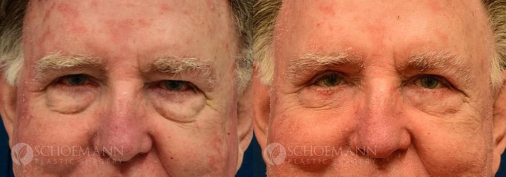 Eyelid Lift Before & After