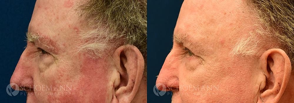 Eyelid Lift Before & After