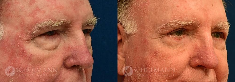 Eyelid Lift Before & After