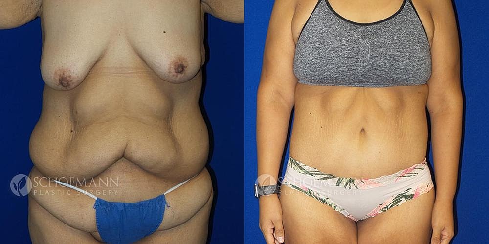 After Weight Loss Surgery Before & After