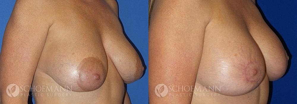 Breast Revision Before & After