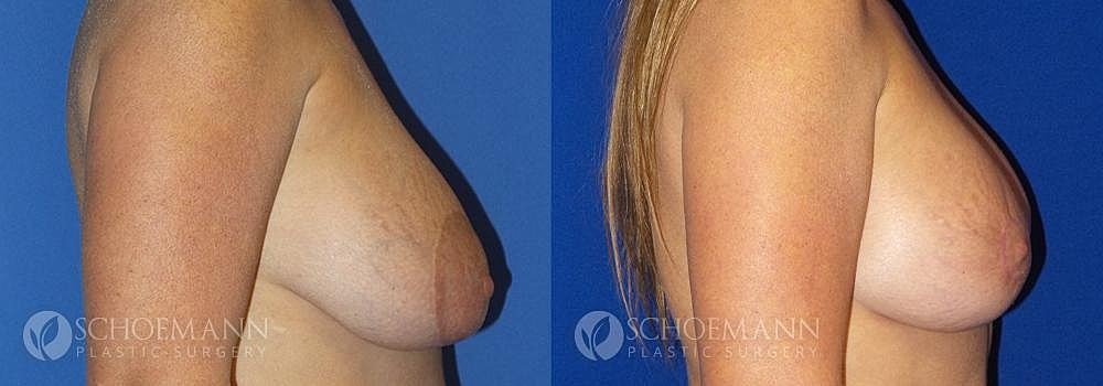 Breast Revision Before & After