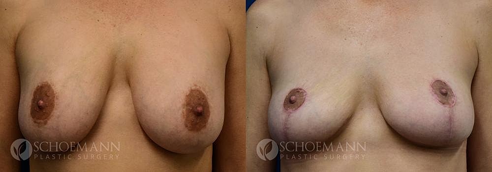 Breast Revision Before & After