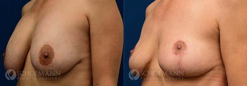 Breast Revision Before & After