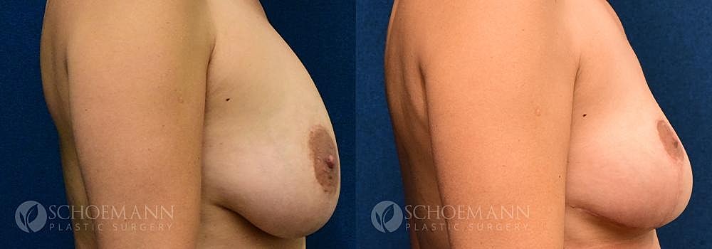 Breast Revision Before & After