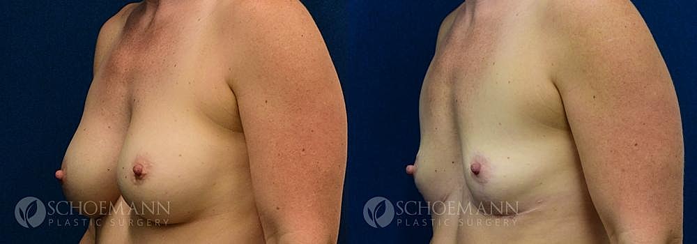 Breast Revision Before & After