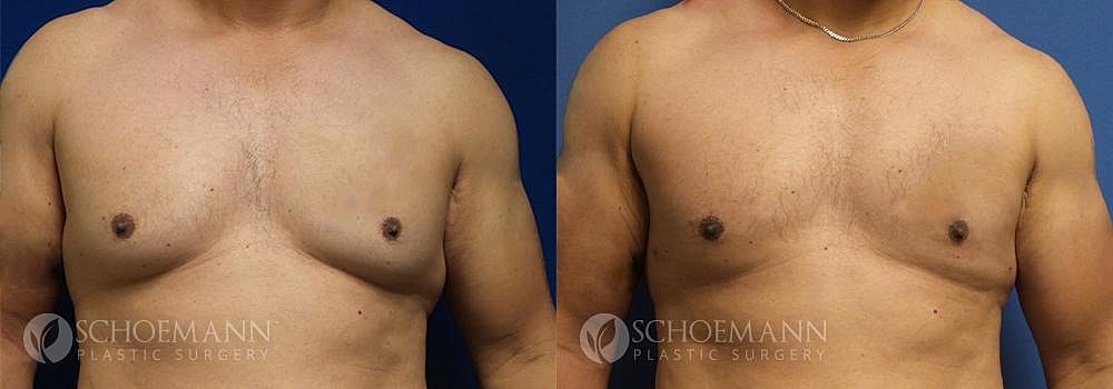 Gynecomastia Before & After