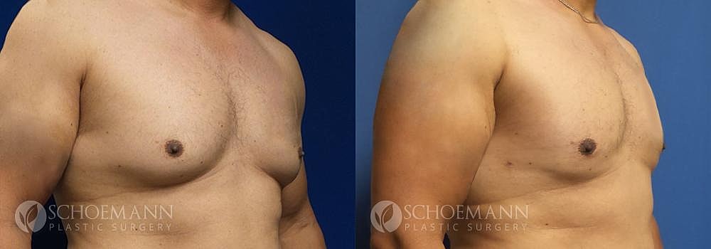 Gynecomastia Before & After