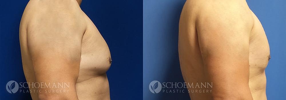 Gynecomastia Before & After