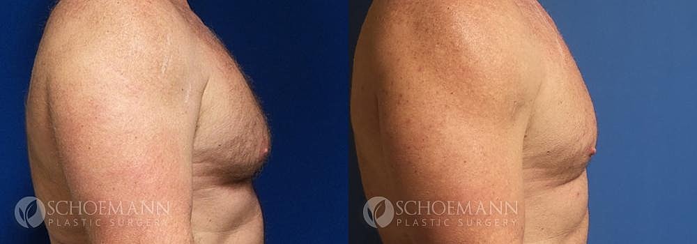 Gynecomastia Before & After