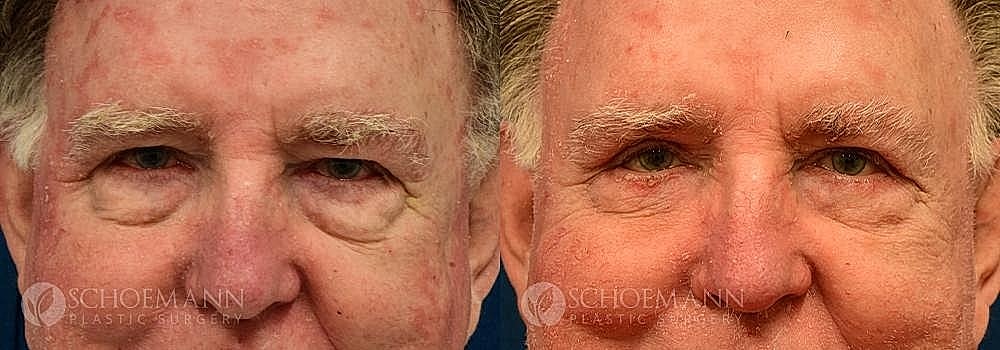 Blepharoplasty Before & After