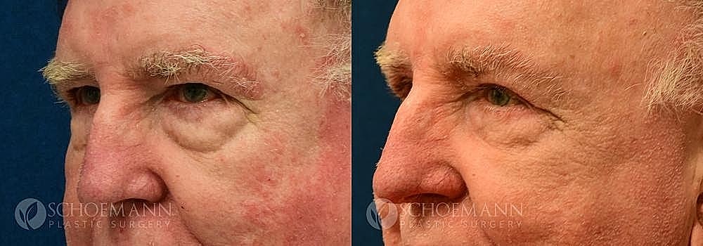 Blepharoplasty Before & After