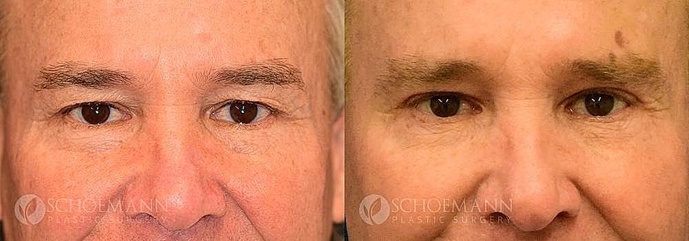 Blepharoplasty Before & After