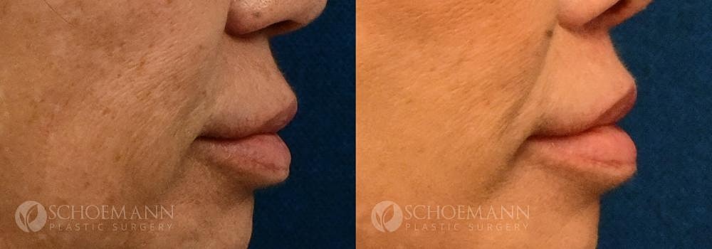 Lip Lift Before & After