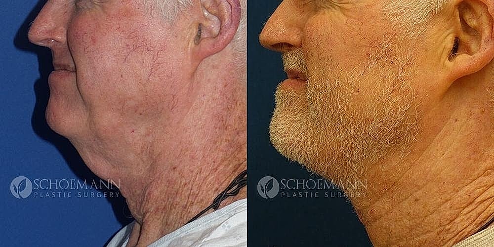 Neck Lift for Men Before & After