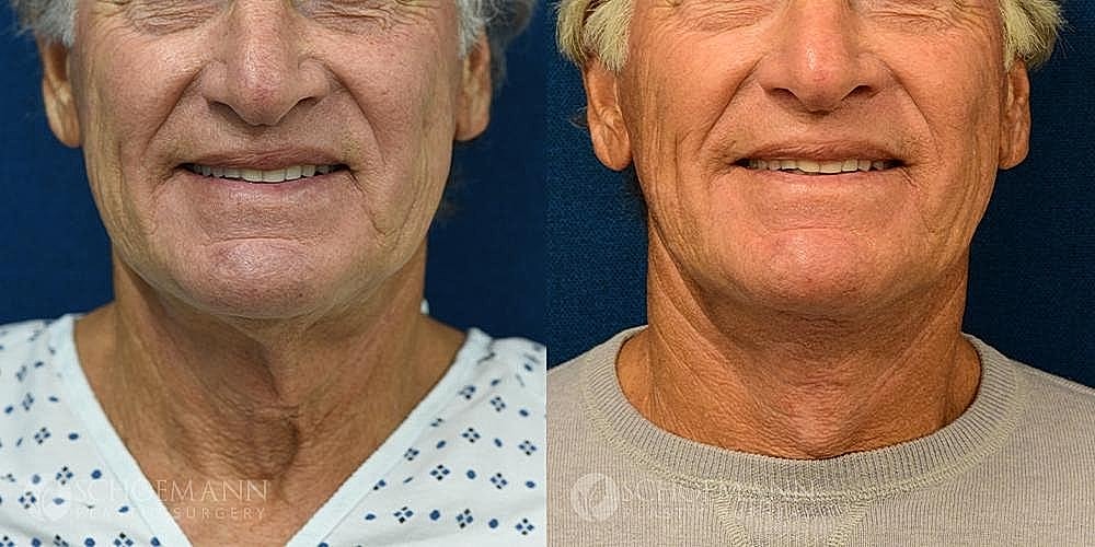 Neck Lift for Men Before & After