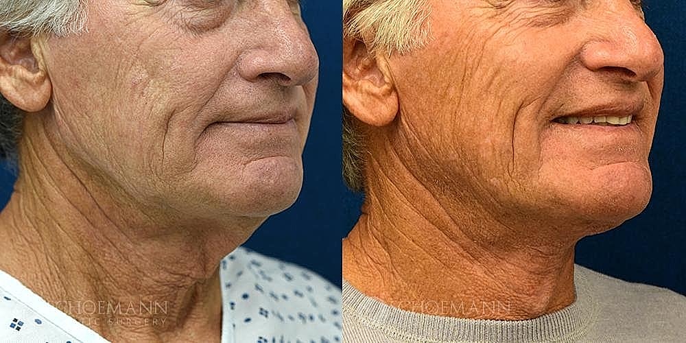 Neck Lift for Men Before & After