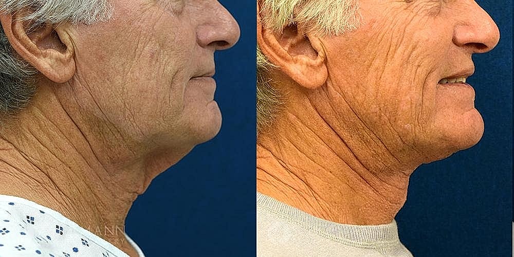 Neck Lift for Men Before & After