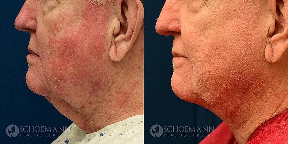 Neck Lift for Men Before & After