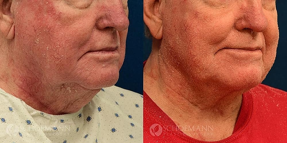Neck Lift for Men Before & After