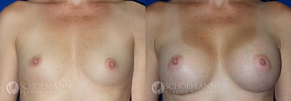Breast Augmentation Before & After
