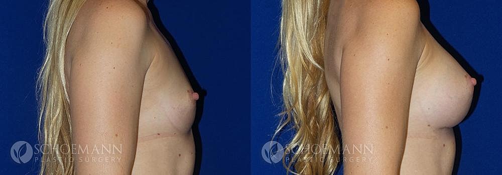 Breast Augmentation Before & After