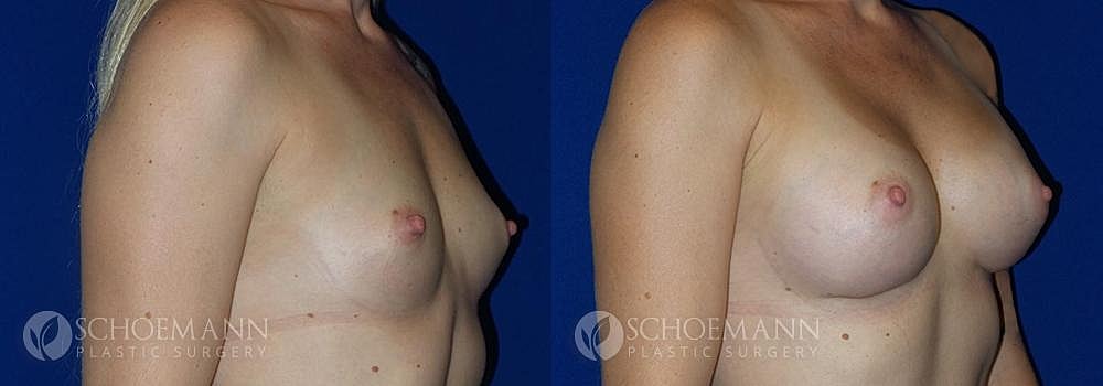 Breast Augmentation Before & After