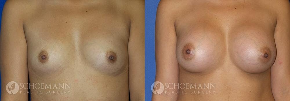 Breast Augmentation Before & After
