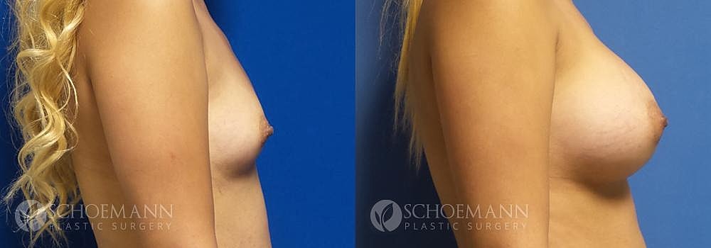 Breast Augmentation Before & After