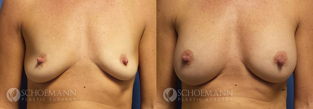 Breast Augmentation Before & After